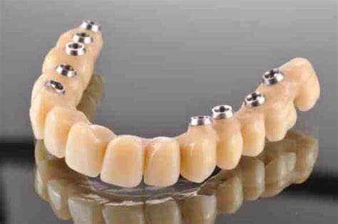  Titanio: Materiale Innovativo per Protesi Ossee e Impianti Dentali!