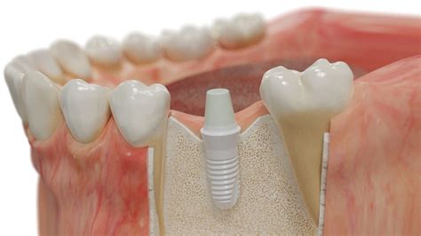  Yttria-Stabilized Zirconia: Un Gigante Ceramico per Impianti Dentali di Lunga Durata!